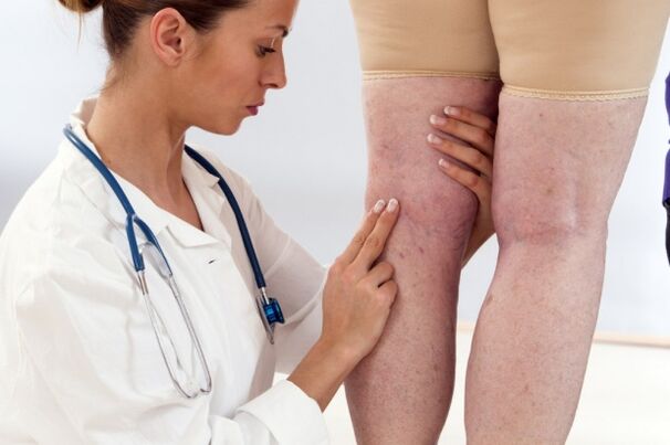 Tratamento das varices nas mulleres