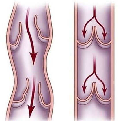 Varices