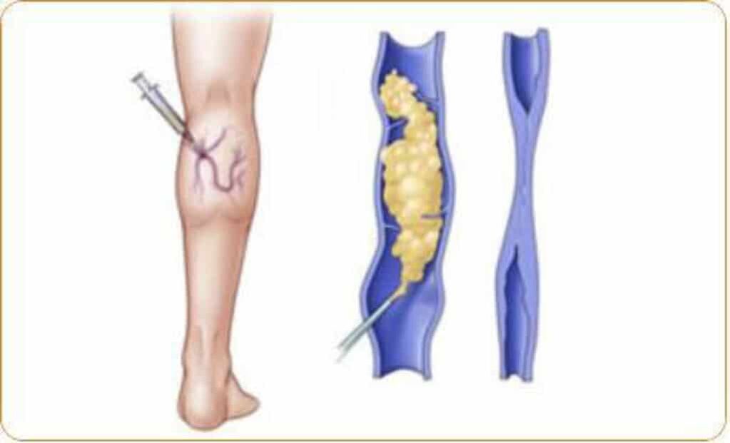 Un exemplo do procedemento de escleroterapia para varices e un resultado claro